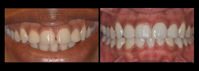 Invisalign-Orthodontics