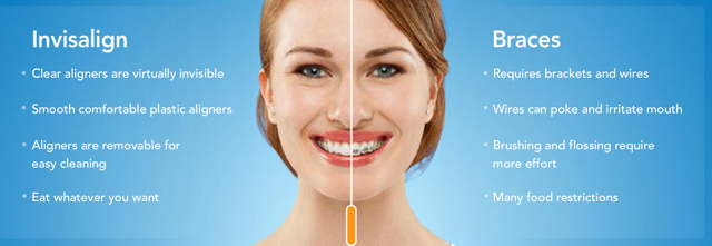 Orthodontics for adults with Invisalign