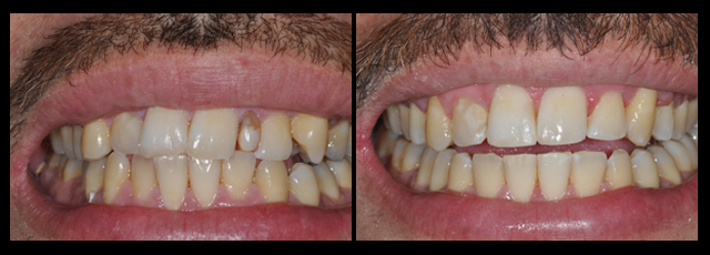 Orthodontics-six-month-smile