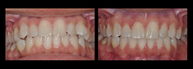 Six-Month-Smile-Ortho