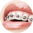 adult-braces