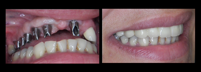 dental implants