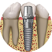 dental-implants