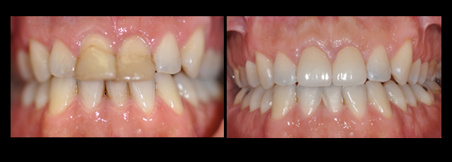 Oakland Porcelain Veneers