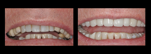 Oakland Full Mouth Dental Implants