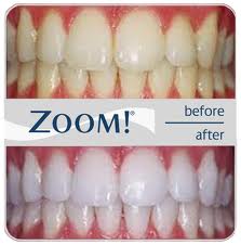 zoom-whitening3