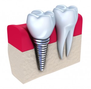 Oakland dentist dental implants