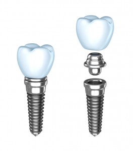 Oakland dental implants