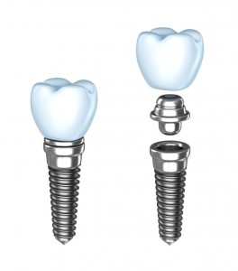 Oakland dental implants