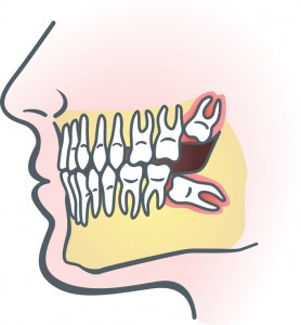 Oakland wisdom tooth extraction