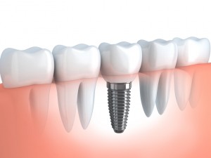 Oakland dental implants