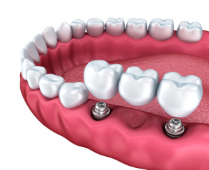 Oakland dental implants